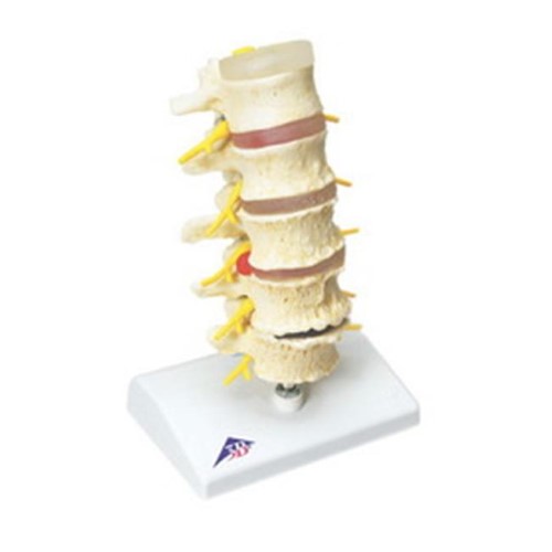 Fabrication Enterprises 12-4542 Anatomical Model Vertebrae Degeneration  Stages of Prolapsed Disc
