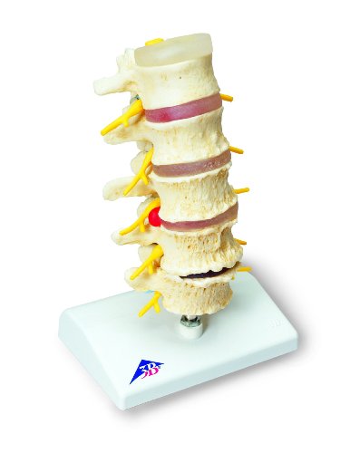 3B Scientific 12-4542 Anatomical Model Vertebrae Degeneration Stages of Prolapse